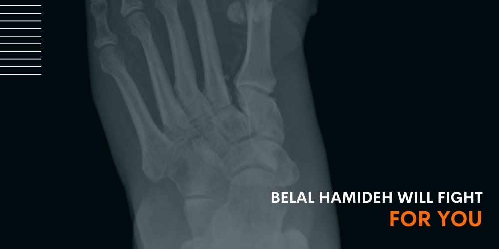Toe Amputation Workmans Compensation toe amputation lawyer