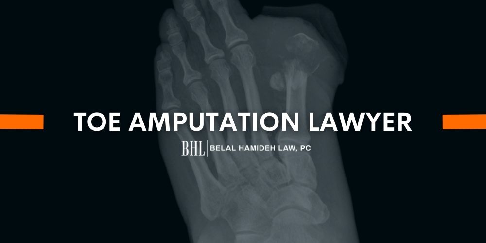 Toe Amputation Workmans Compensation toe amputation lawyer